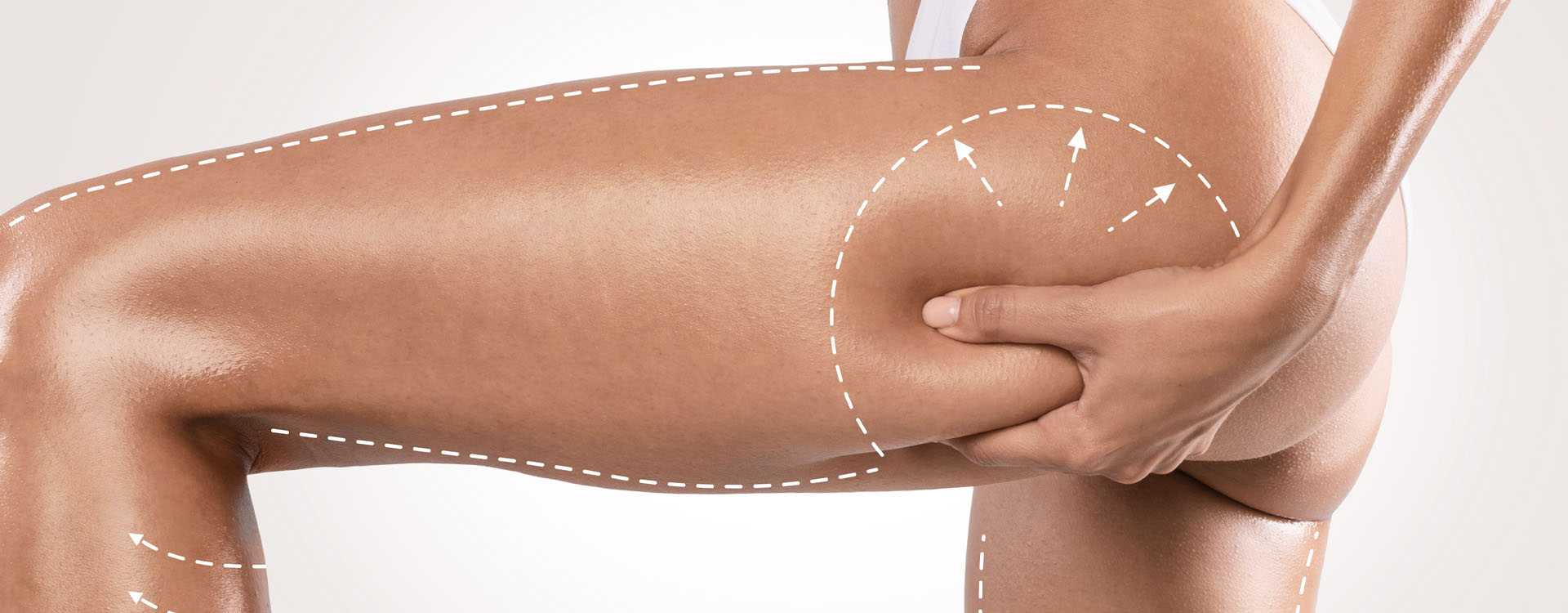 How to apply anti-cellulite creams correctly?