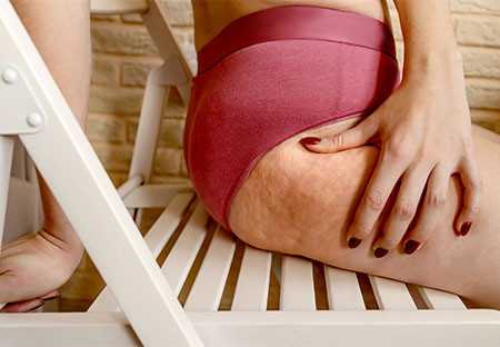 Painful cellulite: what it is, how to recognize it and what to do