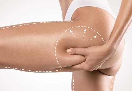 How to apply anti-cellulite creams correctly?